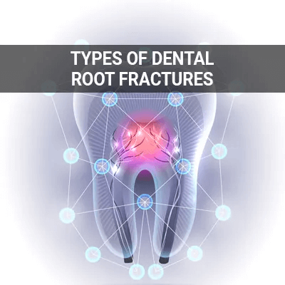 dental root fractures