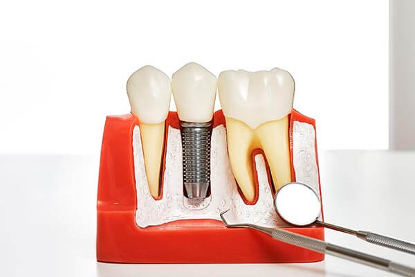 Different Kinds of Dental Implants