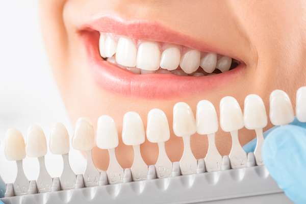 Caring for Veneers