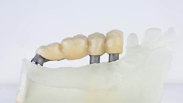 Dental bridges