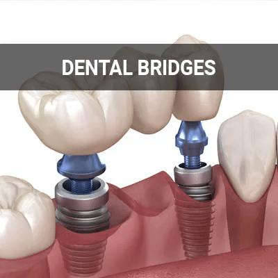 Dental Bridges