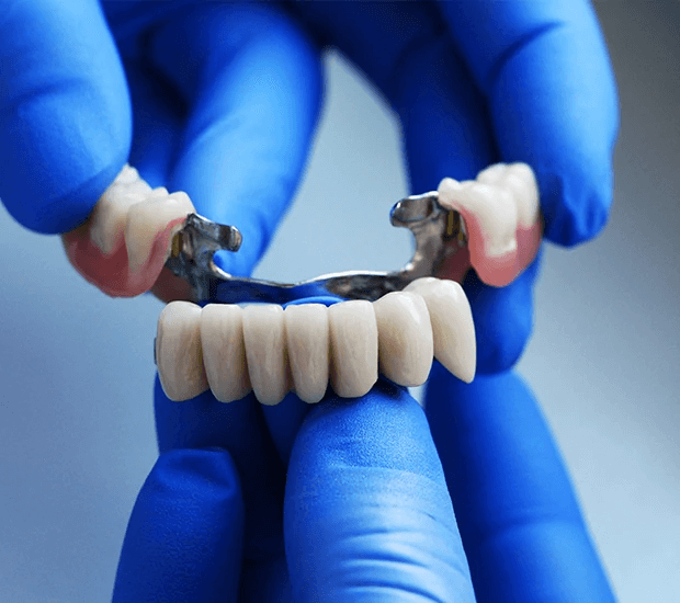 Dental Bridges