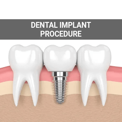 implant procedure