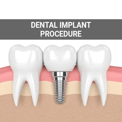 Dental Implants