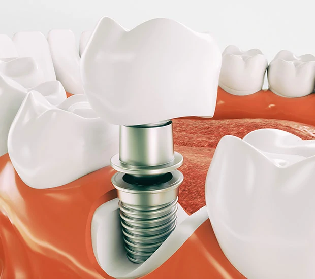 Dental Implants