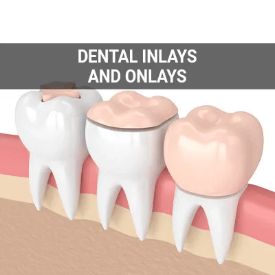 dental inlays