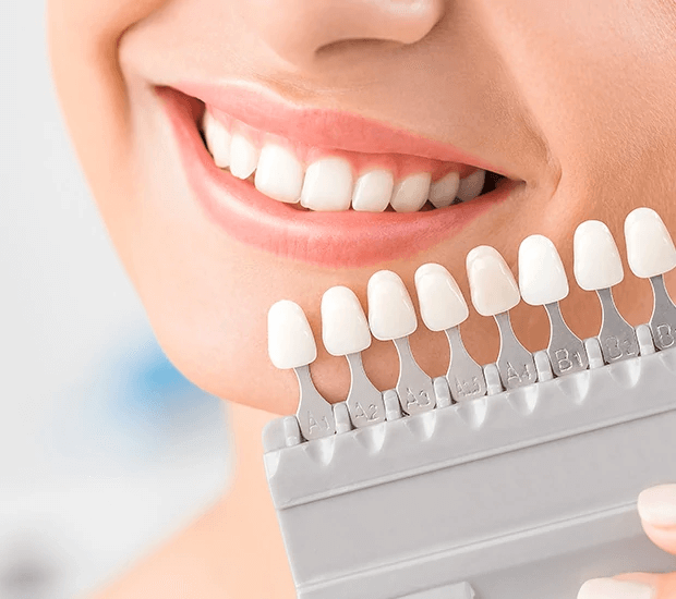 Dental Veneers and Dental Laminates