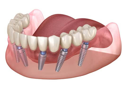 dentures