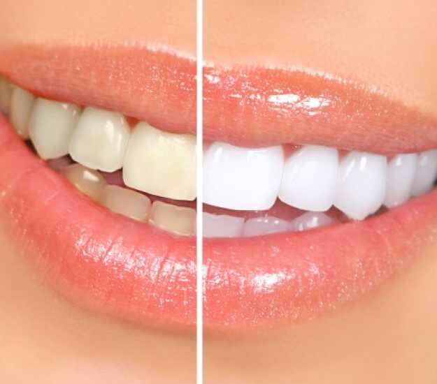 KöR Whitening