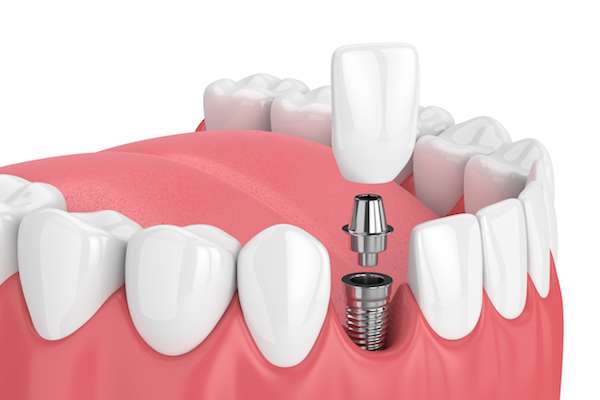 implant animation