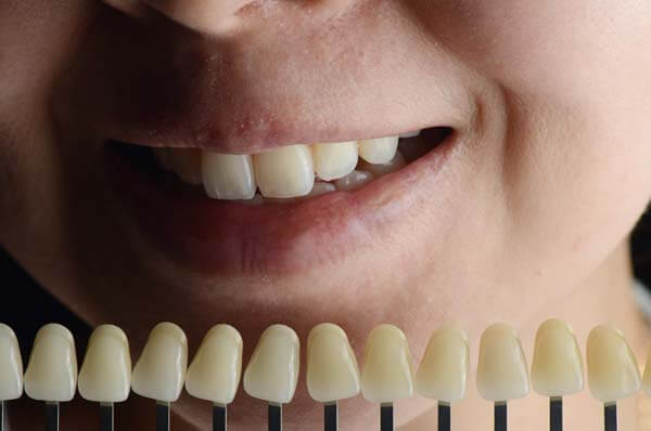 What to Discuss at Your Smile Makeover Consultation