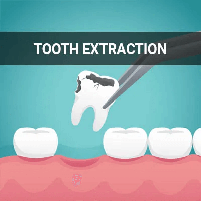 Tooth Extraction