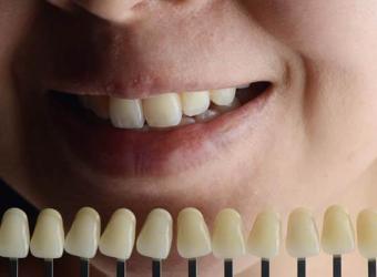 What to Discuss at Your Smile Makeover Consultation